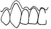 治癒後の歯肉の状態